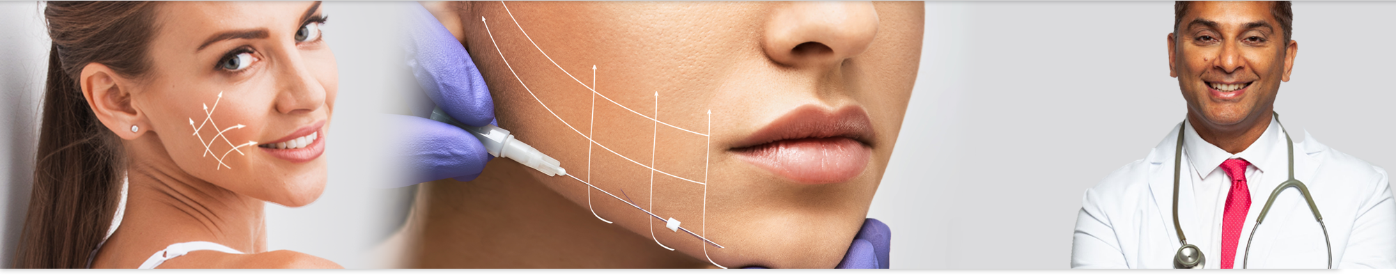 thread lift mississauga oakville non surgical facelift